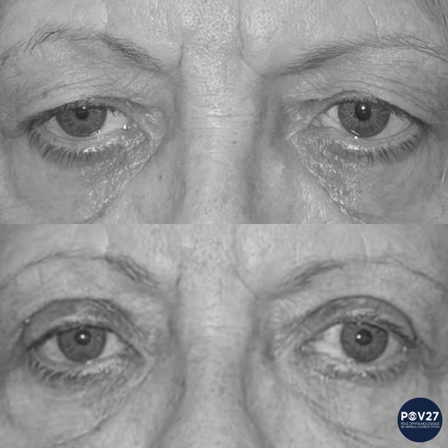 Blépharoplastie supérieure (Avant/Après)
