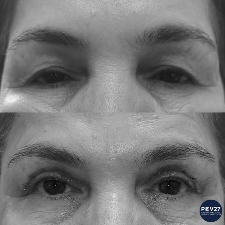 Blépharoplastie supérieure (Avant/Après)
