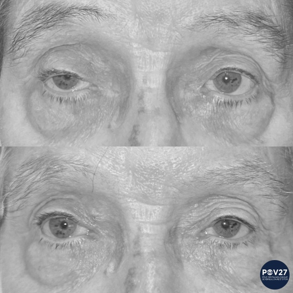 Ptosis OD (voie antérieure Avant/Après)