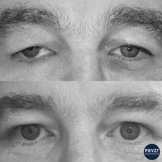Ptosis + blépharoplastie supérieure bilatérale (Avant/Après)