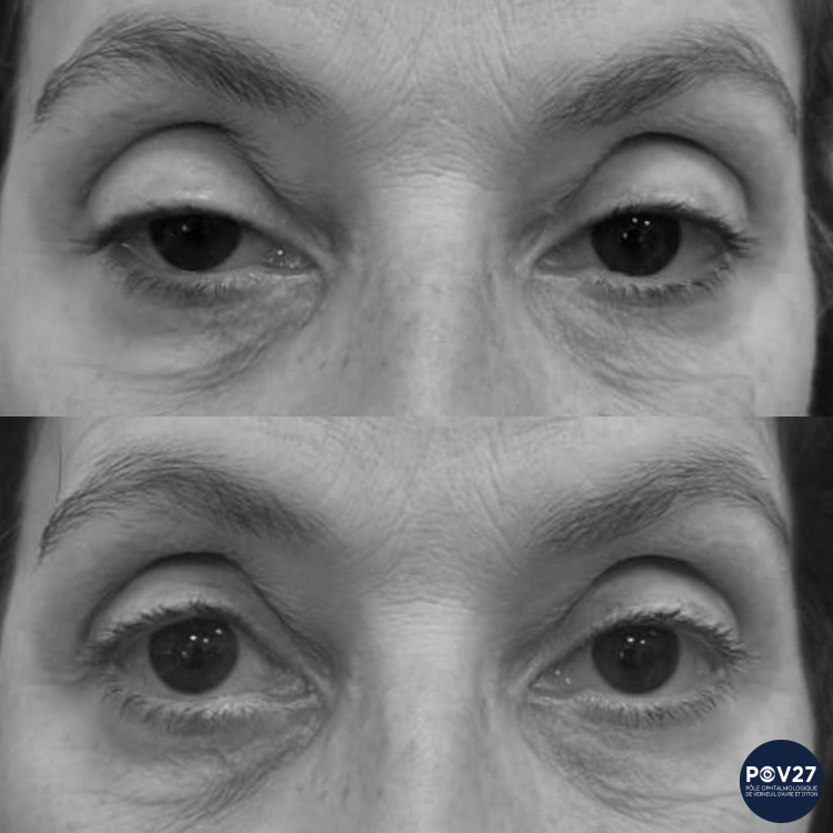 Ptosis OD (Résection conjonctivo-mullerienne Avant/Après)