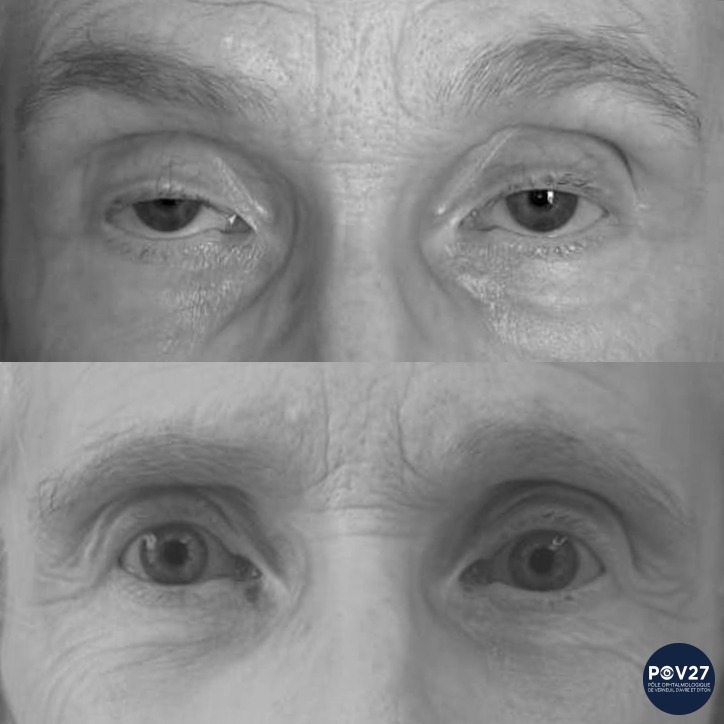 Ptosis bilatéral (voie antérieure Avant/Après)