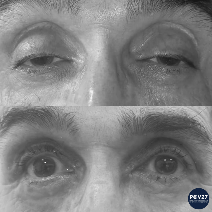 Ptosis bilatéral (voie antérieure Avant/Après)