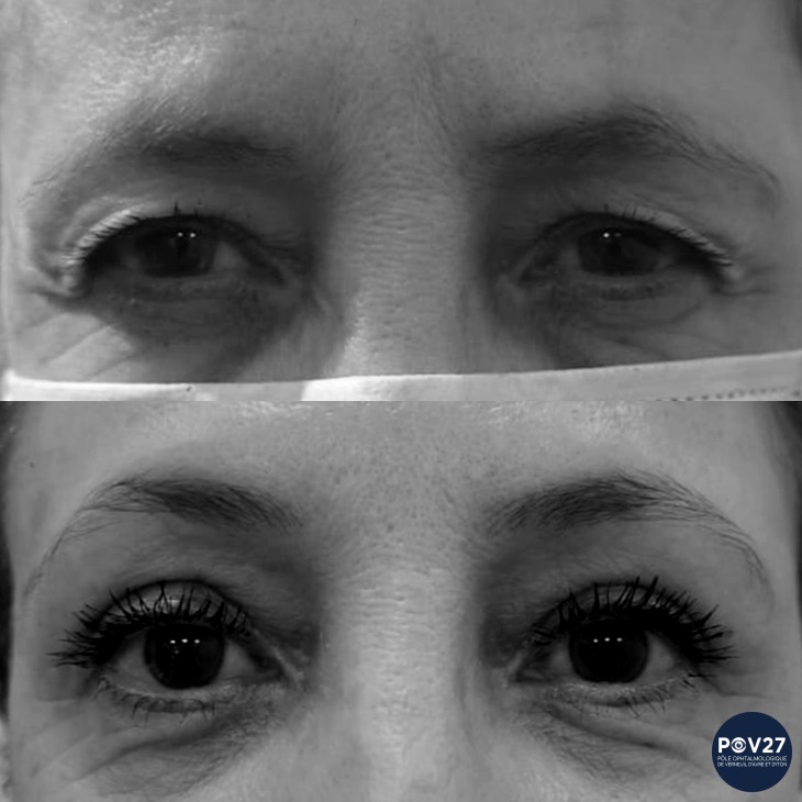 Ptosis + blépharoplastie supérieure bilatérale (Avant/Après)