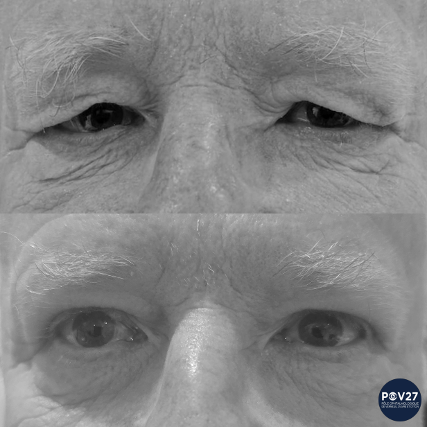 Blepharoplastie supérieure (Avant/Après)